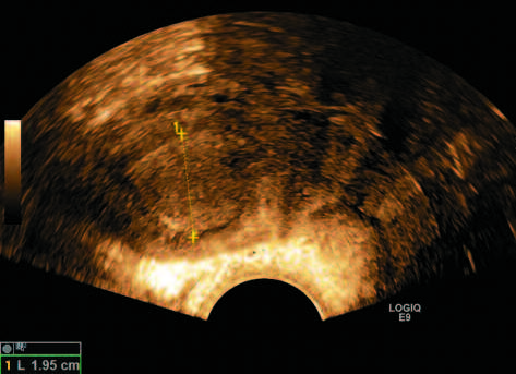 Age-related differential diagnosis of vaginal bleeding in