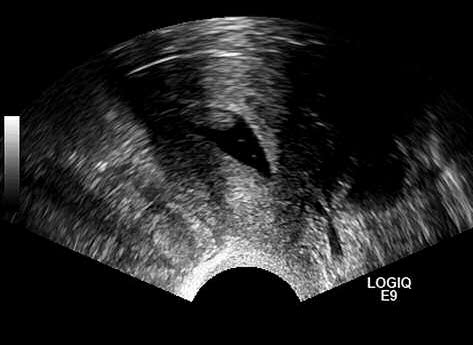 Age-related differential diagnosis of vaginal bleeding in