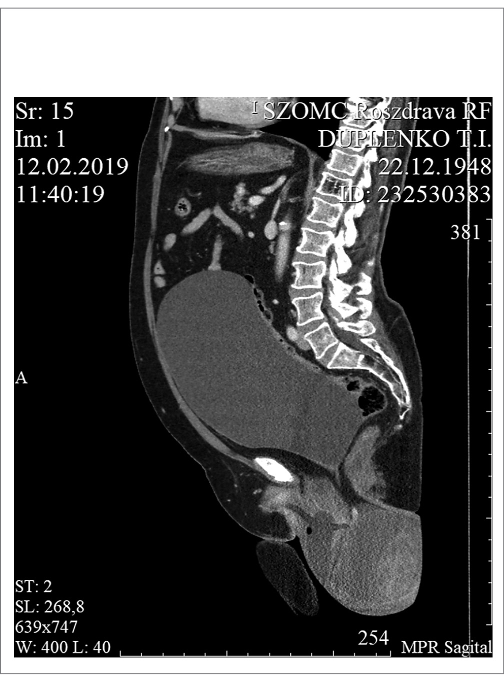 Detection of oncological diseases in patients with pelvic organ prolapse.  Case report - Baibuz - Gynecology